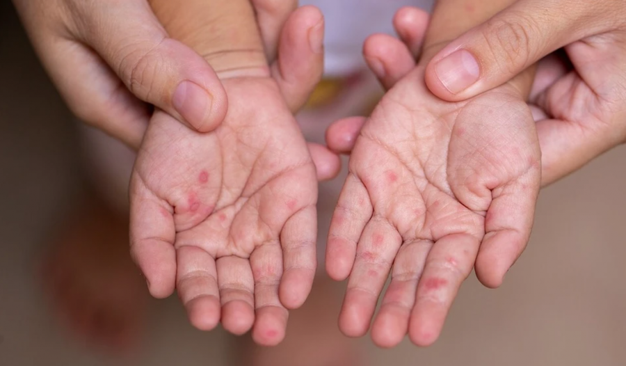 Số mắc sởi đang có xu hướng gia tăng nhanh. (Ảnh: Shutterstock nuotr)