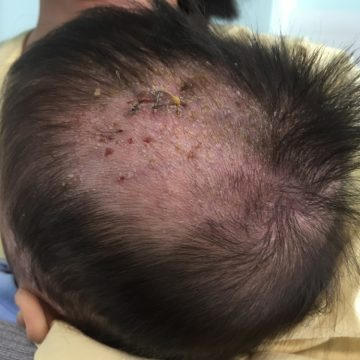 Hình ảnh vùng da đầu tổn thương của bé trai mắc hội chứng mô bào. Ảnh: Bệnh viện Nhi Trung ương
