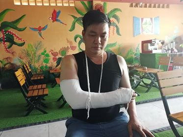 Ông Sơn bị đánh gãy xương tay phải, đa chấn thương phần mềm.