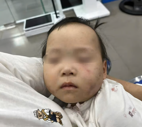 Bé gái bị bầm tím mặt khi được gửi tại cơ sở mầm non tư thục ở Bắc Ninh.