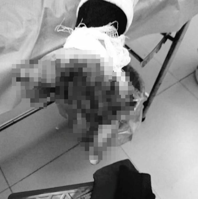 Bàn tay dập nát kinh hoàng của bệnh nhân vì thói quen sử dụng điện thoại khi đang sạc. (Ảnh: Bác sĩ cung cấp)