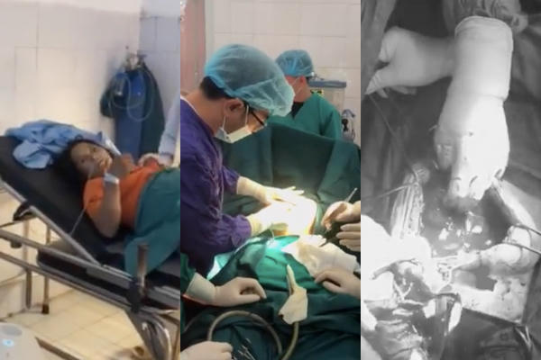 Bác sĩ mổ cấp cứu cắt tử cung và lấy thai chết lưu cho sản phụ C 