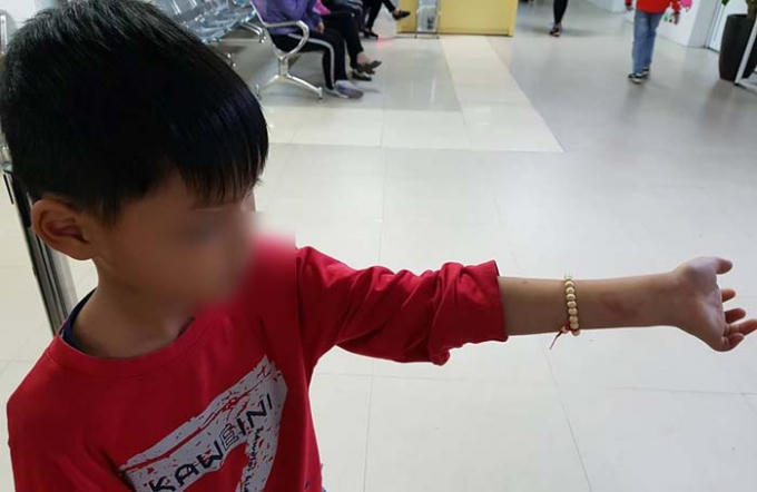 Ngoài vết tím ở lưng, còn nhiều vết tím khác trên cơ thể em Phú