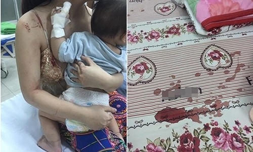 Bé Na - con chị Dung bị chuột cắn nát tay và vết máu thẫm ga giường. (Ảnh minh họa)