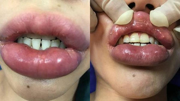Tiêm filler làm đẹp, cô gái tều môi vì gặp biến chứng
