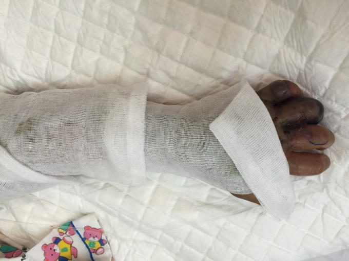 B&ecirc;̣nh nhi bị rắn cắn. Ảnh: BVCC