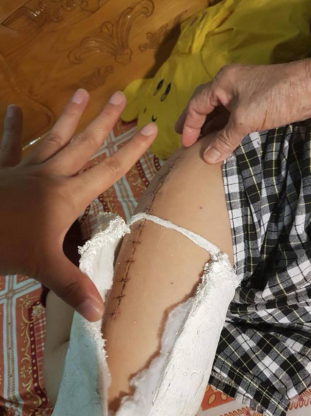 Vết khâu trên chân cháu Kiên sau khi bị ngã (ảnh gia đình cung cấp)