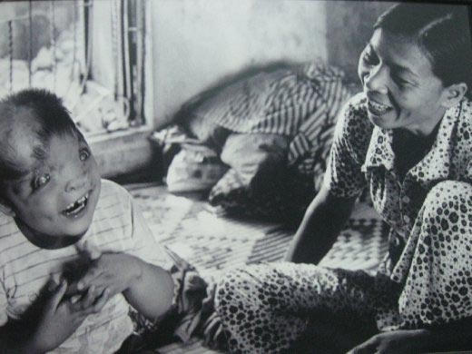 Một em bé bị tật bẩm sinh vì phơi nhiễm chất độc da cam. Ảnh: World Nomads Journals