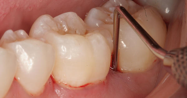 Ngộ độc thuốc tê là biến chứng cực kỳ nguy hiểm. Ảnh: minh họa