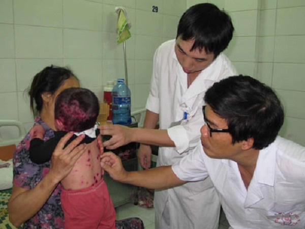 Tuy lành tính, nhưng rất dễ nhiễm trùng da nơi mọc mụn nước có thể dẫn đến nhiễm trùng huyết, viêm não. Ảnh minh họa.