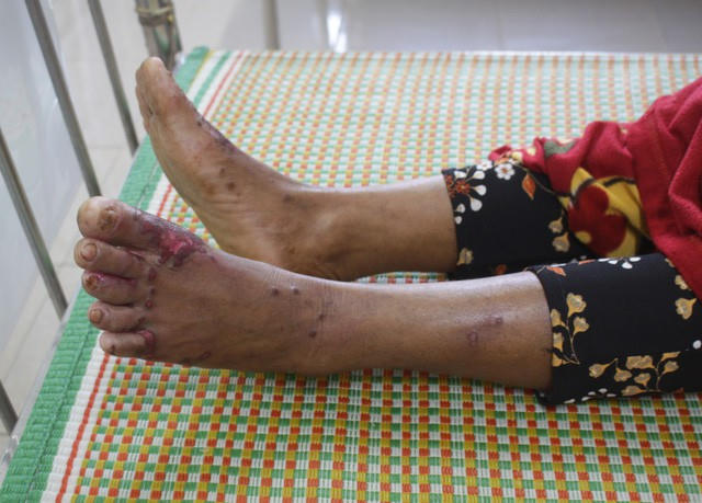 Bệnh nhân mắc "bệnh lạ" có biểu hiện dày sừng, lở loét ở bàn tay, bàn chân và có chỉ số men gan tăng cao bất thường.