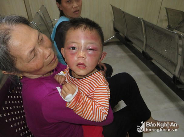 Cháu H trong tình trạng thâm tím mặt mày, hai mắt sưng vù. Ảnh: báo Nghệ An