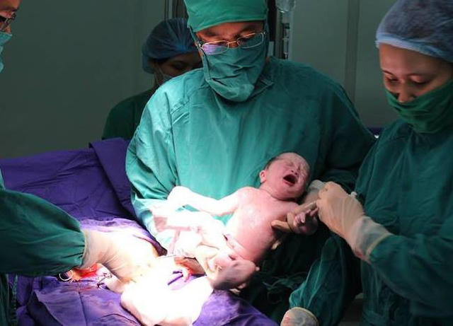 Trường hợp song thai IVF đầu tiên ra đời tại Bệnh viện Sản Nhi Quảng Ninh và đặc biệt đây là trường hợp song thai cùng trứng, 1 bánh rau 1 buồng ối (ảnh Bệnh viện cung cấp)