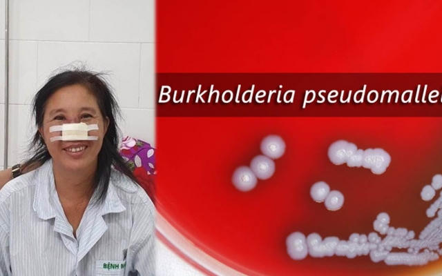 Bệnh nhân Whitmore tổn thương mũi đã được xuất viện