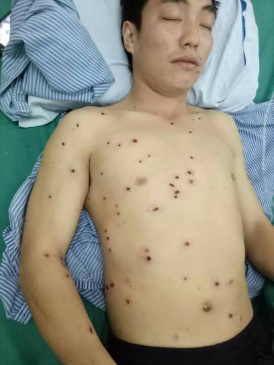Anh Liên đang điều trị tại bệnh viện đa khoa tỉnh Hà Giang. (Ảnh: Phàn Giào Họ).