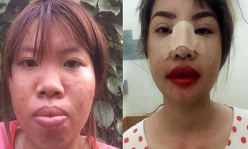 Quách Thị Kim Phượng trước và sau khi phẫu thuật thẩm mỹ.