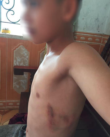 Học sinh Tuấn với vết bầm trên người do bị hành hung.