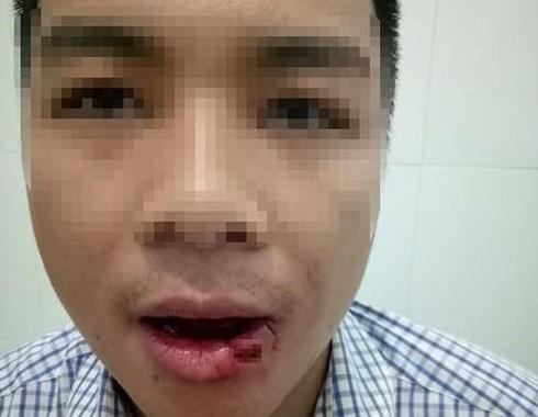 Nhân viên tòa bị thầy giáo ném thanh sắt gãy 5 răng.