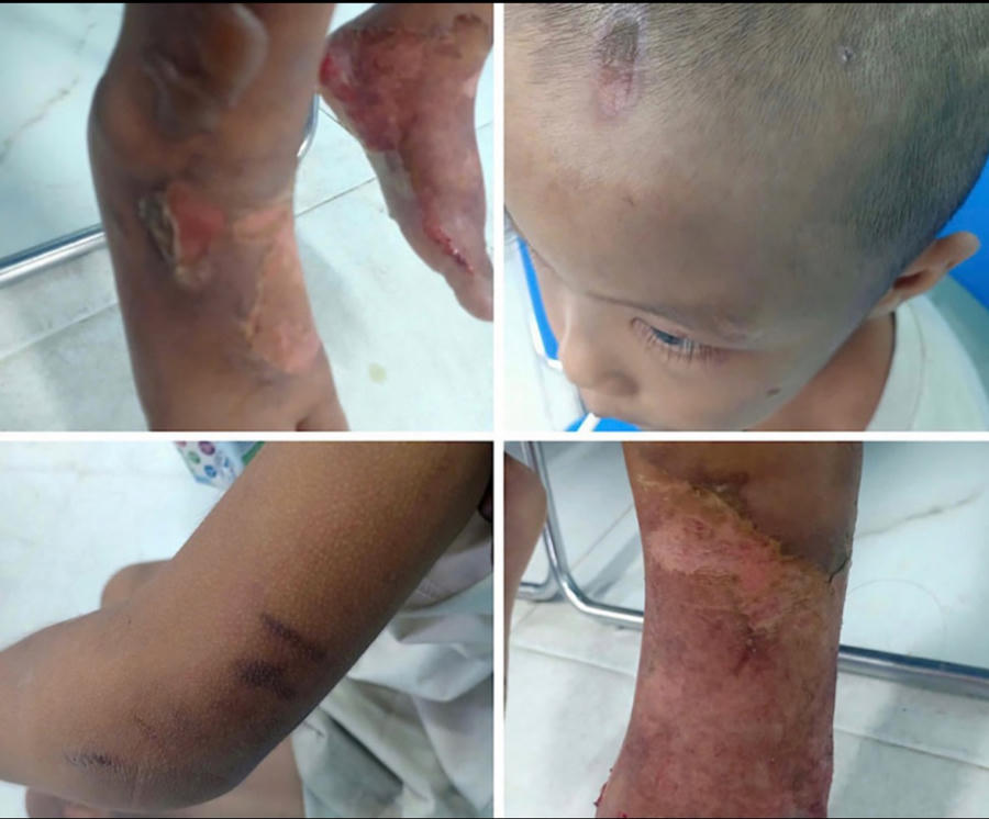 Cháu bé với những vết thương nghi do cha đẻ bạo hành.