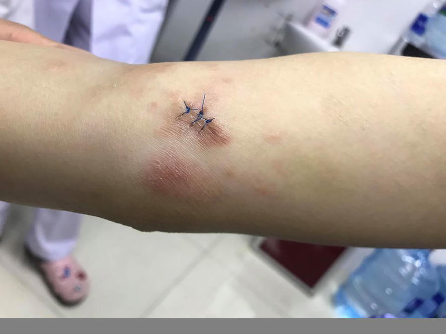 Tưởng viêm da cơ địa, hóa ung thư da xâm lấn