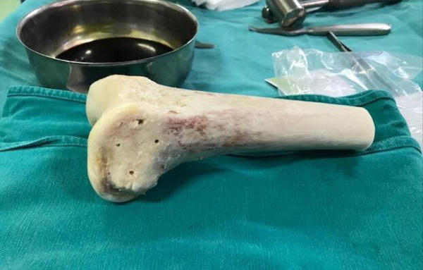 Phần xương từ người cho chết não trước khi ghép cho bệnh nhân
