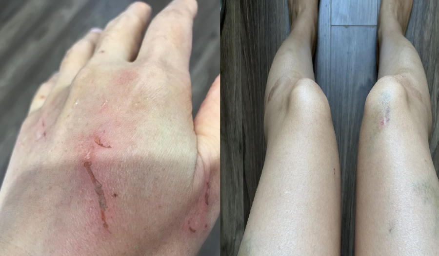 Vết rách tay và bầm tím trên cơ thể chị P.