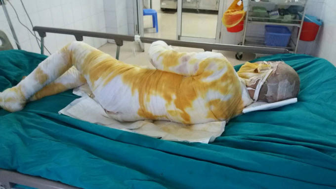 Chị M. đang được điều trị tích cực tại Bệnh viện bỏng Quốc Gia.