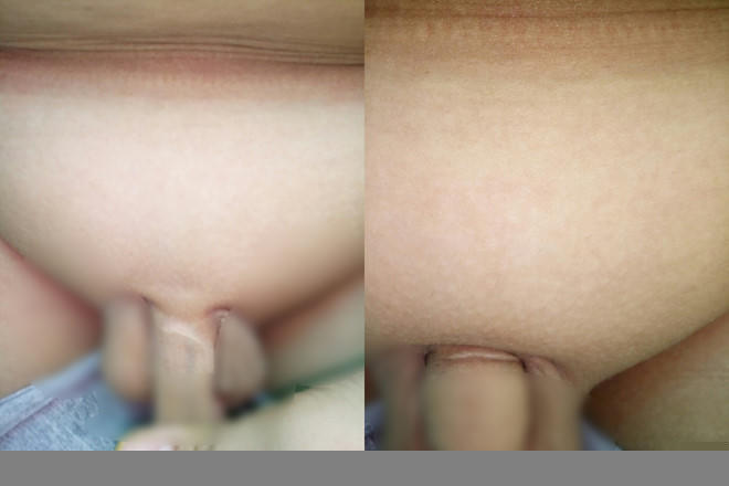 Vết sẹo dài hơn 1 cm trên dương vật bé K  Ảnh Trần Cường