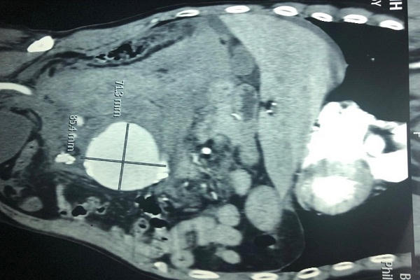 Túi phình động mạch chủ bụng của bệnh nhân bị vỡ gây máu chảy ồ ạt trong ổ bụng - Ảnh: T.N