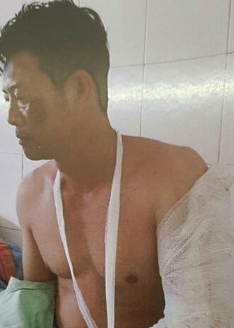 Ông Hậu bị chém gần đứt lìa cánh tay.