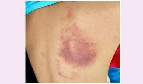 Vết thương vùng lưng của cháu Phú do cô giáo dùng thước kẻ đánh.