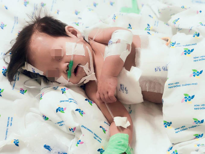 Bệnh nhi thủng thực quản, tràn mủ màng phổi, cấy mủ ra 2 loại siêu vi khuẩn  kháng tất cả kháng sinh. Ảnh: BVCC