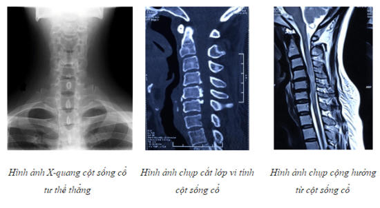 Hình ảnh tổn thương cột sống cổ gây liệt không hoàn toàn. Ảnh: TQK