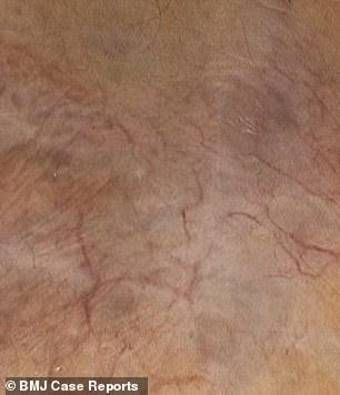 Vết bầm 1 cm kéo dài suốt 6 năm hóa ra là 1 căn bệnh ung thư hiếm gặp