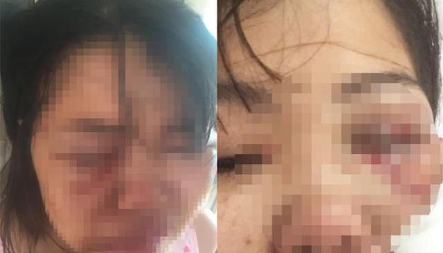 Hình ảnh chị Đ. bị chồng đánh thâm tím mặt mày.