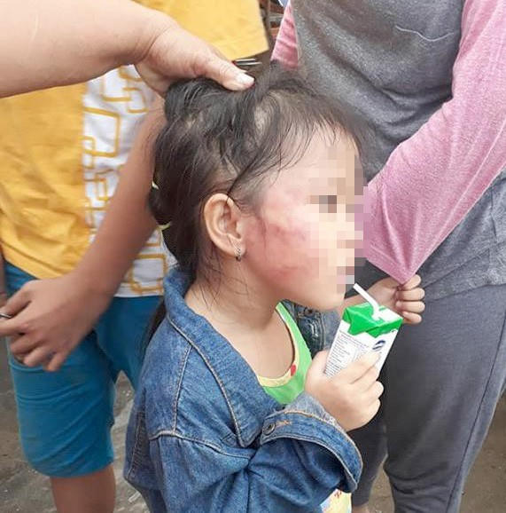 Cháu bé không bị gãy xương hàm như thông tin được chia sẻ trên mạng xã hội
