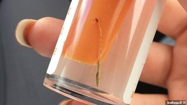 Mầm c&acirc;y b&ecirc;n trong tai Eli Smit. Ảnh:&nbsp;MSN