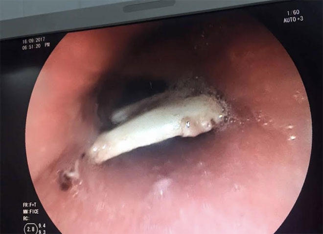 Miếng xương được gắp ra khỏi thực quản bệnh nhân.