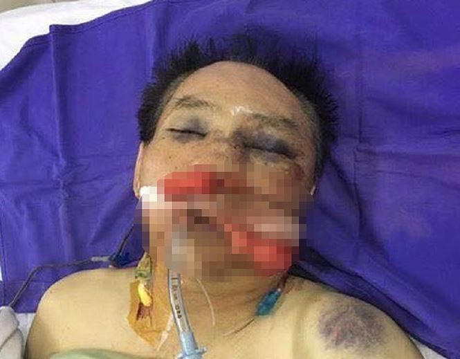 Nạn nhân nhập viện sau khi bị em trai và một số đối tượng hành hung dã man.