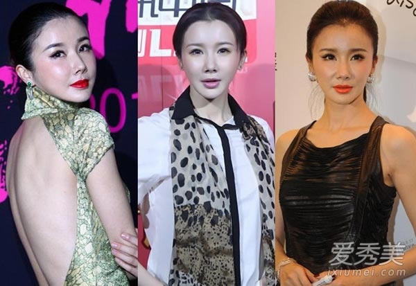 Tôn Phi Phi - người đẹp cổ trang một thời - có khuôn mặt ngày càng biến dạng và vô biểu cảm do di chứng phẫu thuật thẩm mỹ.