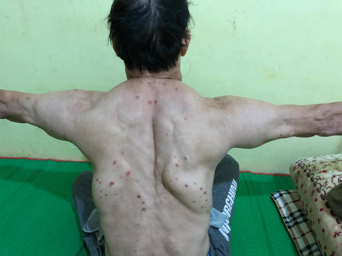 Các khối u mọc đối xứng trên người bệnh nhân và to lên với tốc độ nhanh chóng.
