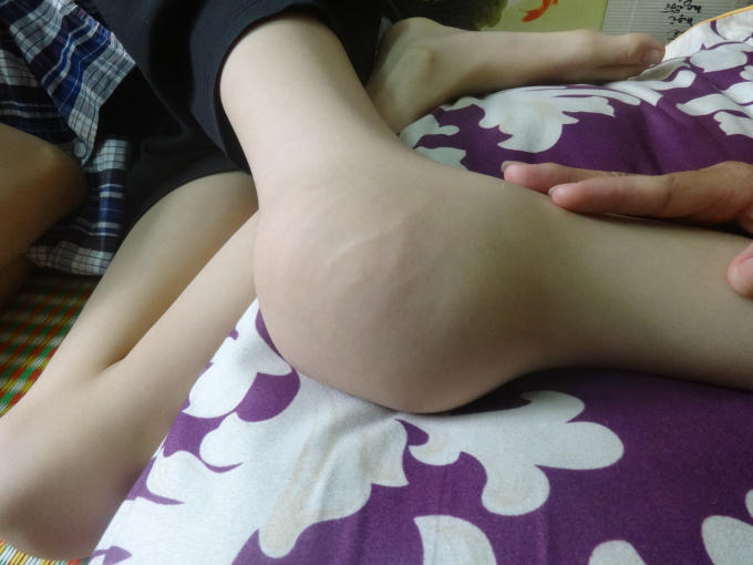 Một bệnh nhân bị biến dạng khớp gôi do bệnh lý Hemophili. Ảnh: Ngọc Nga