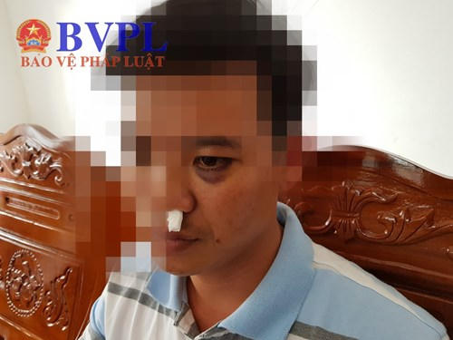 Sau gần một tuần điều trị các vết thương của thầy Bảo, hiện sức khỏe đã ổn, mắt cũng đã giảm bầm tím. Tuy nhiên, thầy vẫn chưa đến trường giảng dạy được, vì đang có triệu chứng đau đầu choáng váng và đang phải ở nhà để điều trị. Ảnh: NC.