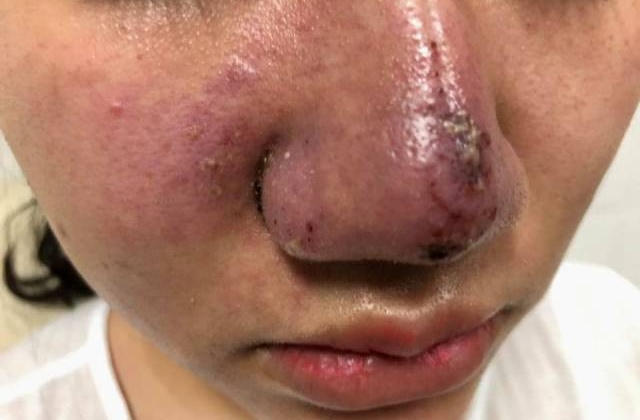 Thêm một ca méo mặt, bọc mủ vì tiêm filler làm đẹp