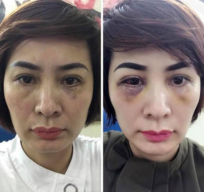 Mắt của chị Trần Lệ Thúy sau gần 1 tháng cắt mỡ mí dưới tại Thẩm mỹ viện Lilia.