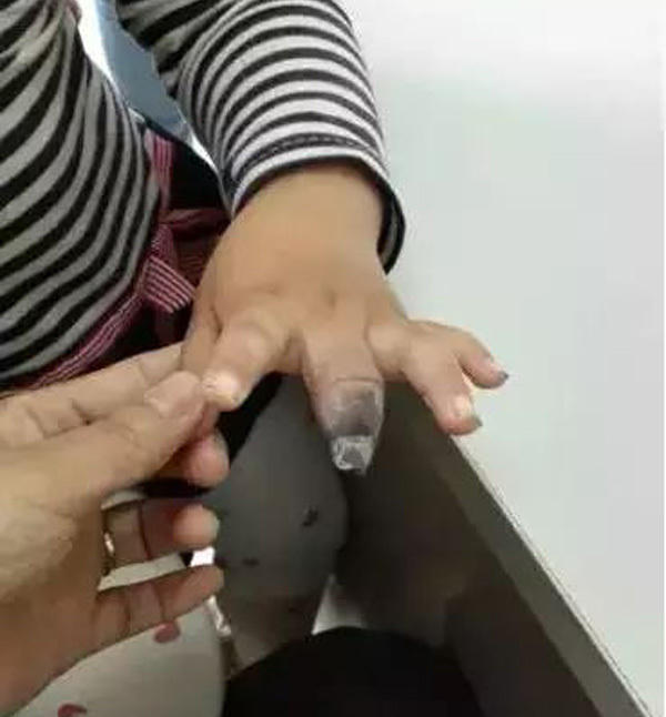 Dán băng urgo quá chặt và để lâu không thay đã khiến ngón tay của bé gái 4 tuổi bị hoại tử.