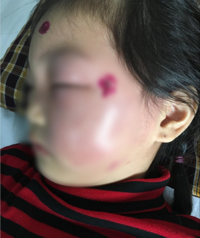 Khuôn mặt sưng phù của bé gái do nhiễm trùng huyết. BVCC