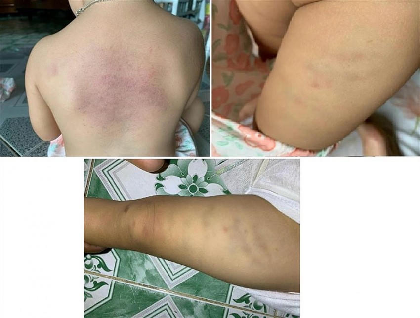 Nhiều vết bầm tím trên người cháu bé. Ảnh: https://bocongan.gov.vn