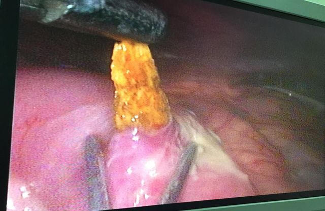 Mảnh xương dài 3cm đâm thủng ruột người đàn ông