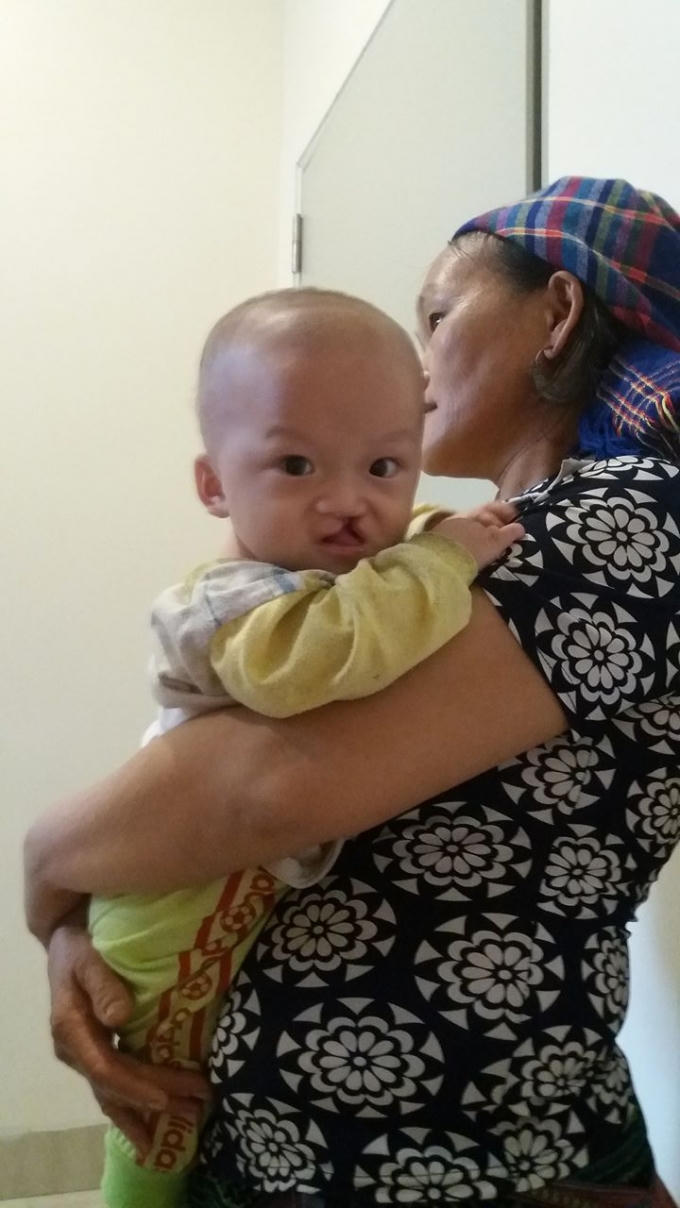 Sứt môi, hở hàm ếch là do yếu tố di truyền.
